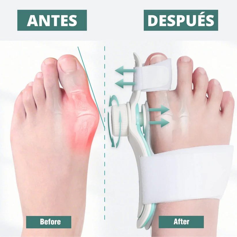 CORRECTOR DE JUANETES PROFESIONAL ⭐⭐⭐⭐⭐